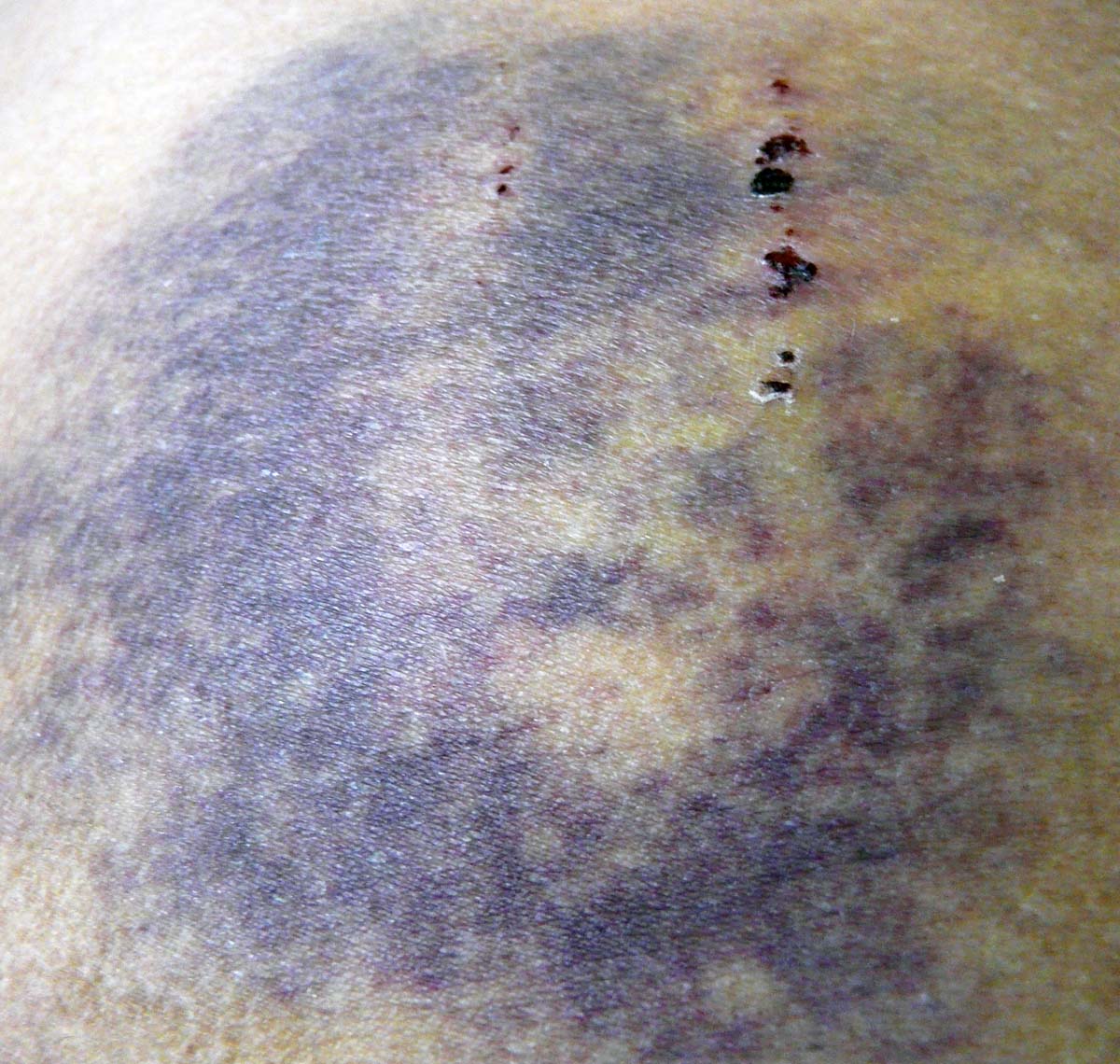 Bad bruise bad bike fall bruise
